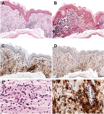 Epstein-Barr Virus-Associated T and NK-Cell Lymphoproliferative Diseases